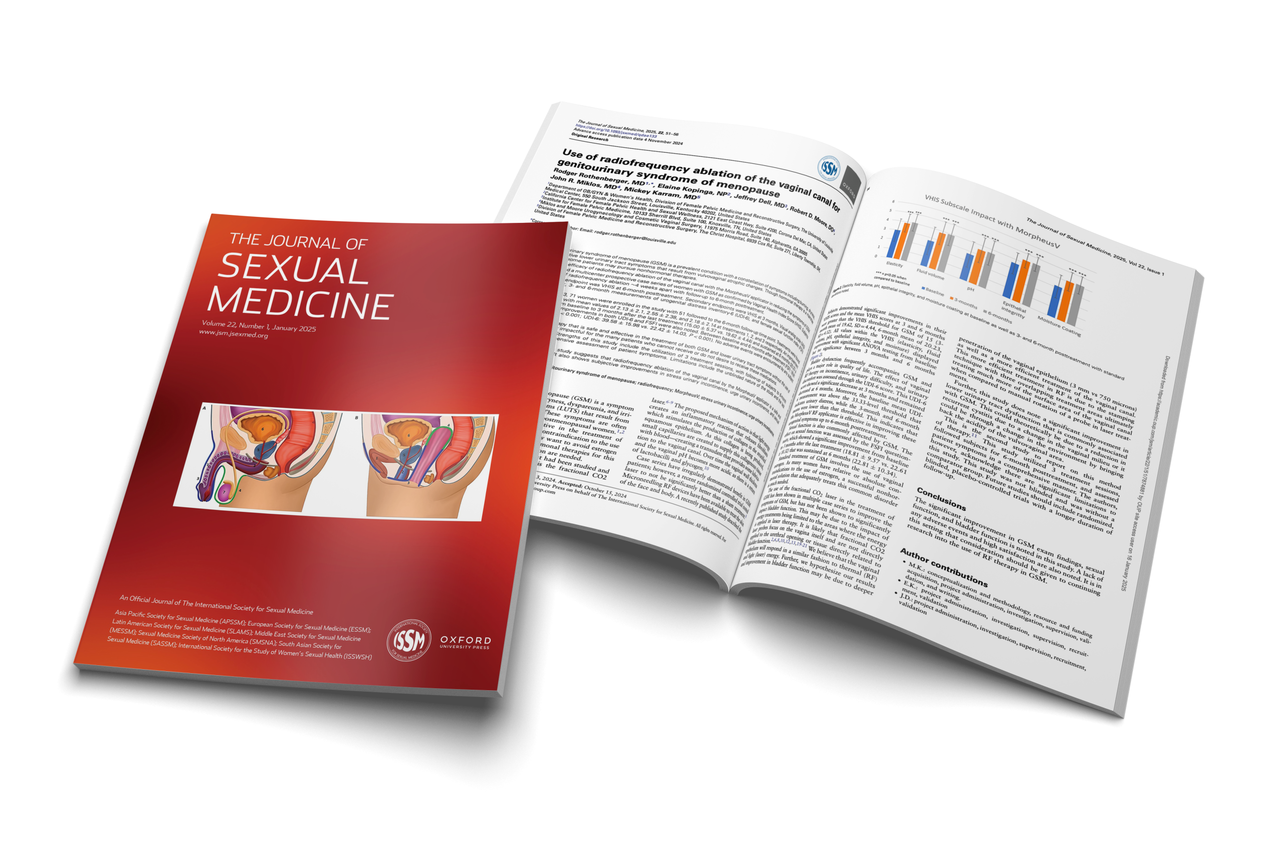 Use of radiofrequency ablation of the vaginal canal for genitourinary syndrome of menopause