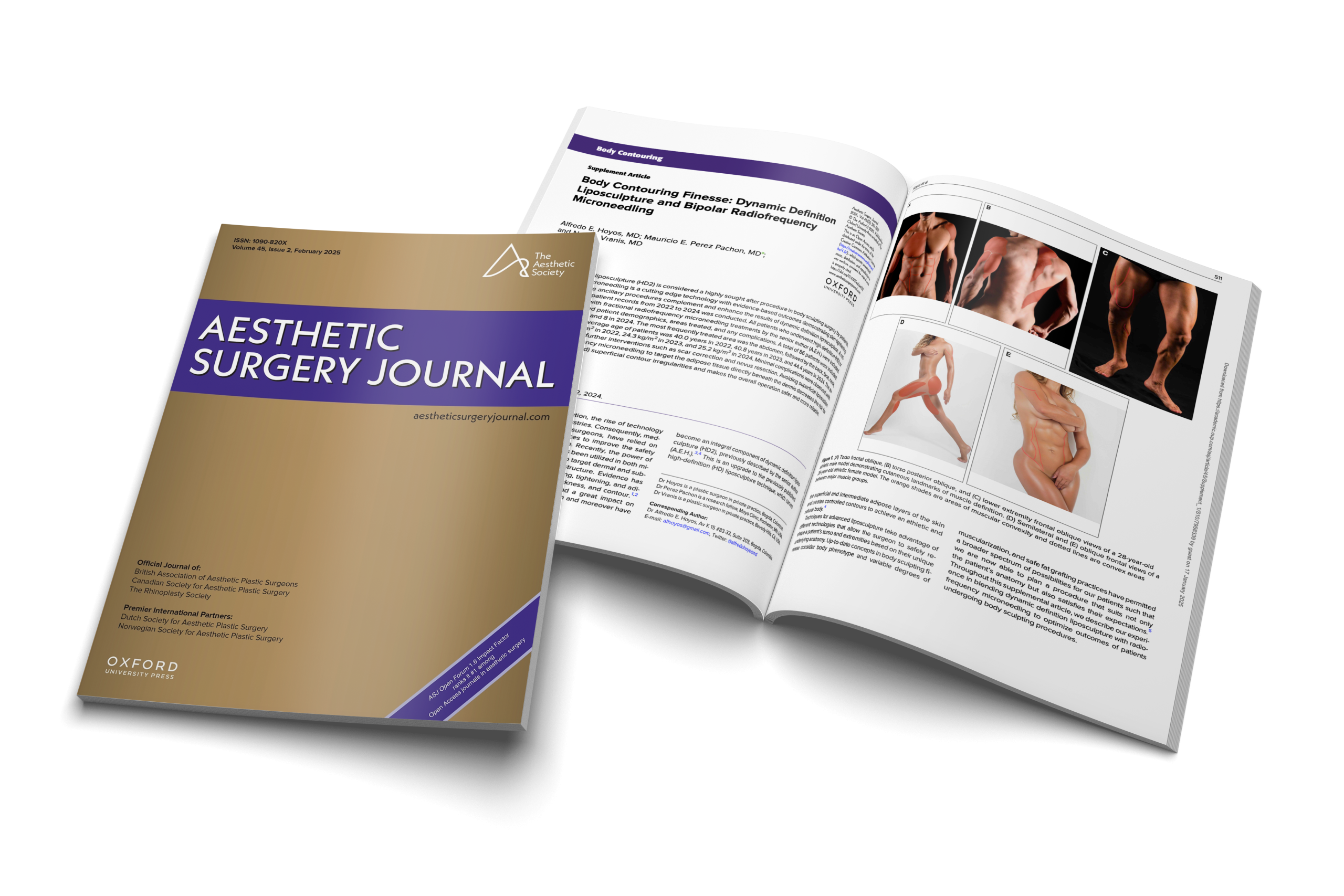 Body Contouring Finesse: Dynamic Definition Liposculpture and Bipolar Radiofrequency Microneedling
