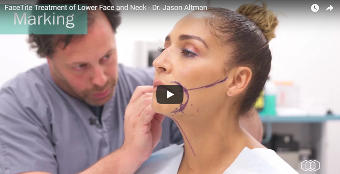 Live Demo: Neck Lift & Chin Lift with FaceTite – Dr. Jason Altman