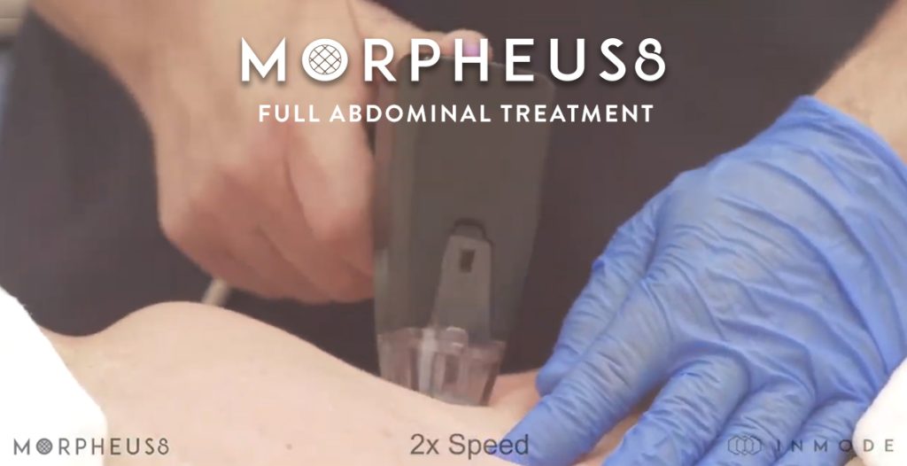 Live Demo: Abdominal Skin Tightening with Morpheus8 RF
 - Dr. Nicholas Nikolov