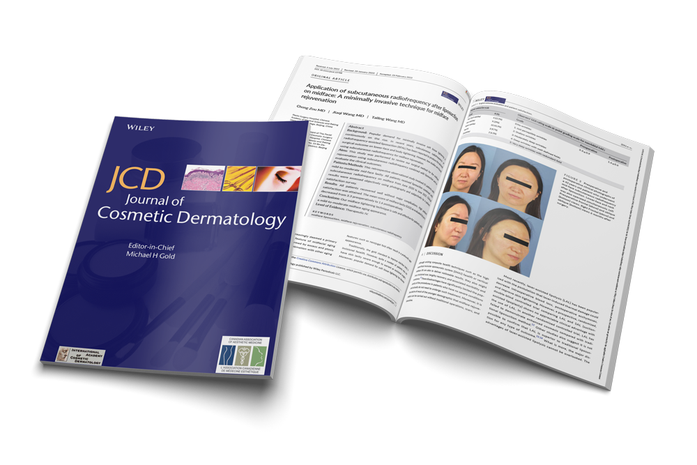 RFAL for Midface Rejuvenation