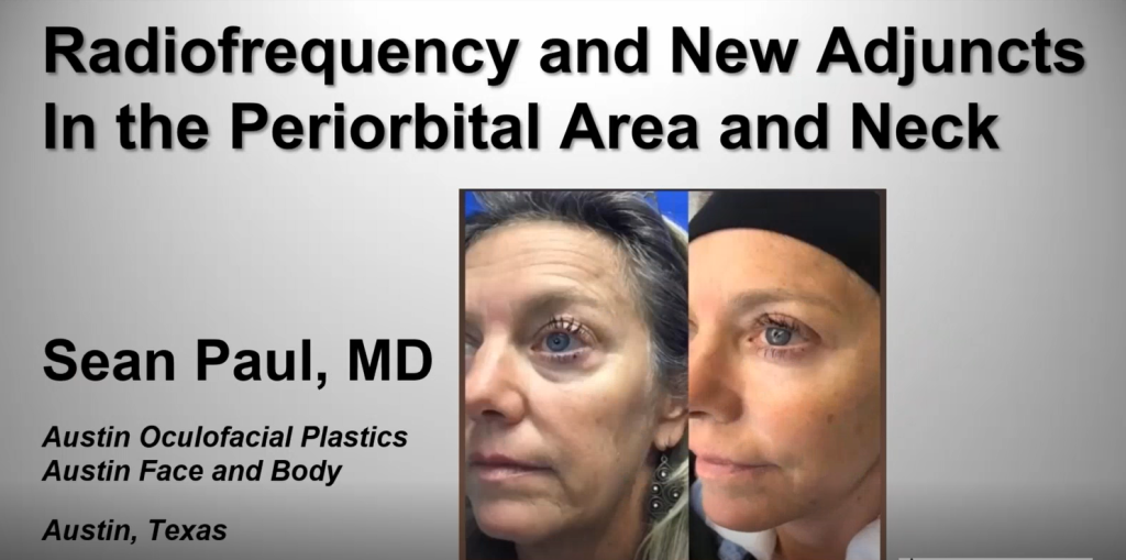 Webinar: Lower Eyelid Rejuvenation with AccuTite & Morpheus8 - Dr. Sean Paul, Dr. Spero Theodorou
