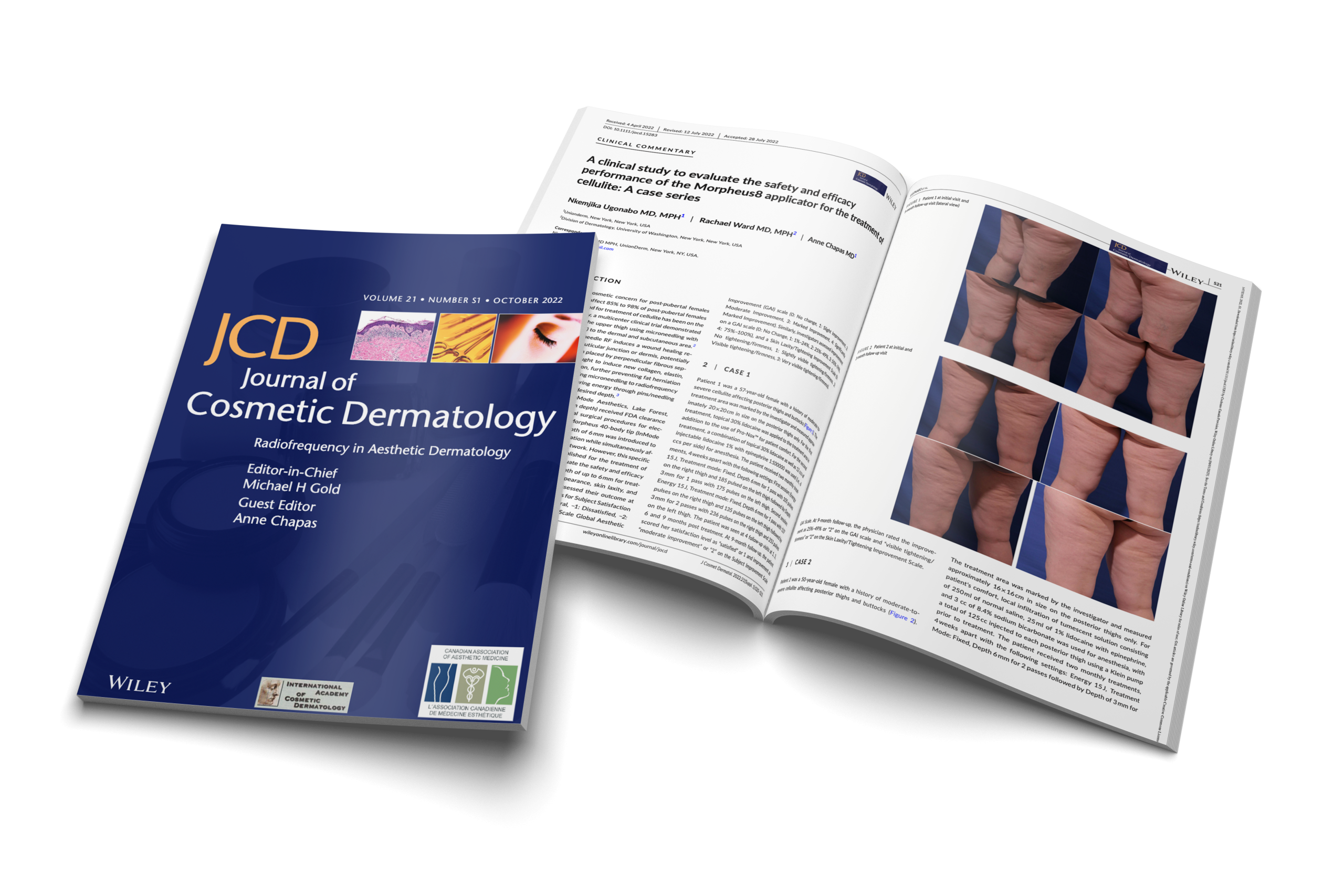 A clinical study to evaluate the safety and efficacy performance of the Morpheus8 applicator for the treatment of cellulite: A case series