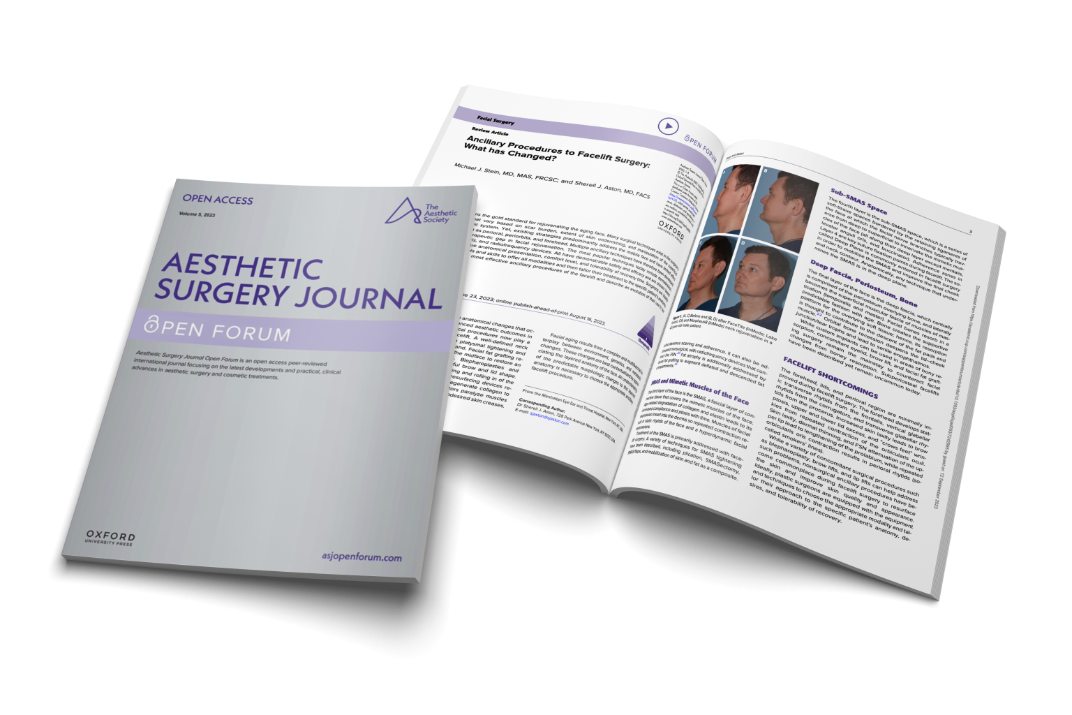 Study: RFAL for Midface Rejuvenation