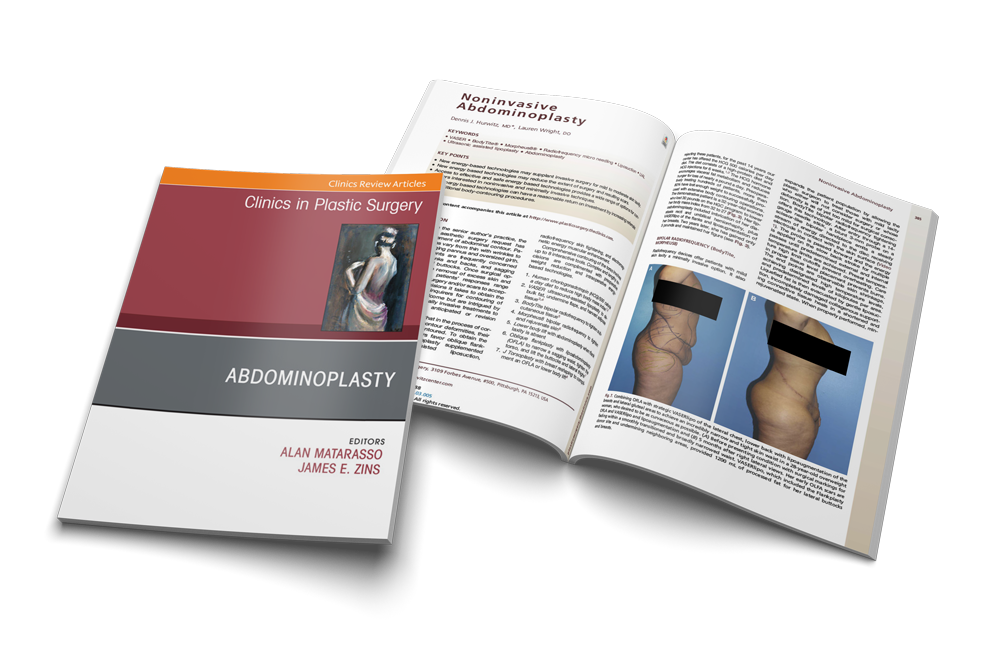 Noninvasive Abdominoplasty