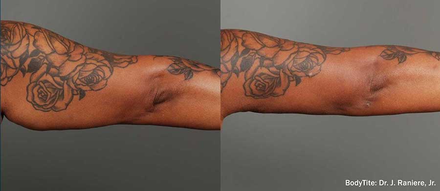 BodyTite-Before-and-After-Arms