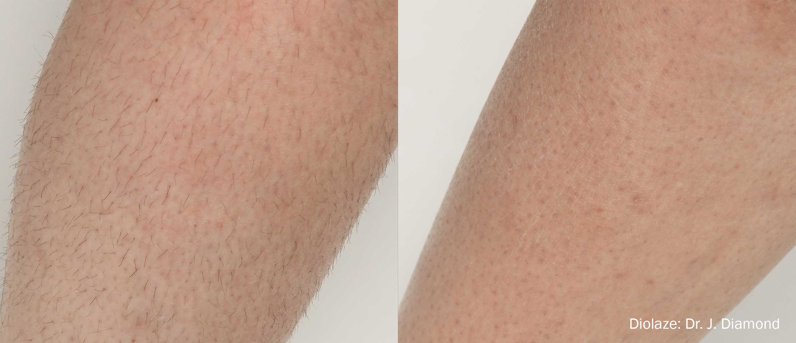 Diolaze Before and After