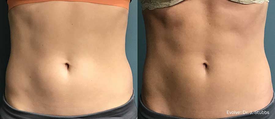 Evolve-Before-and-After-Defined-Abs
