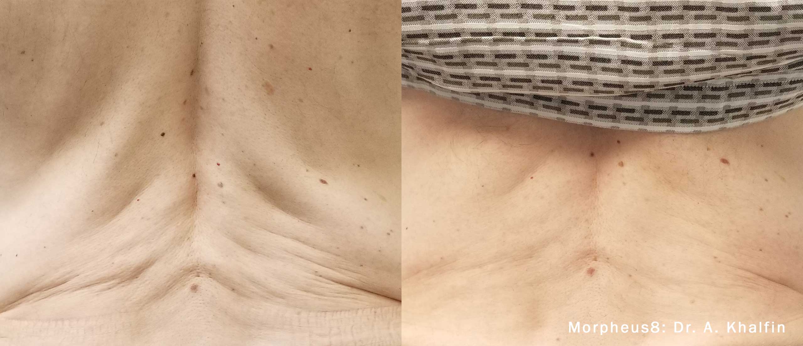 Morpheus8 Before and After - Backrolls, Backfat