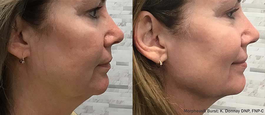 Morpheus8-Before-and-After-Jawline-Contouring