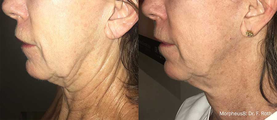 Morpheus8-Before-and-After-Turkey-Neck