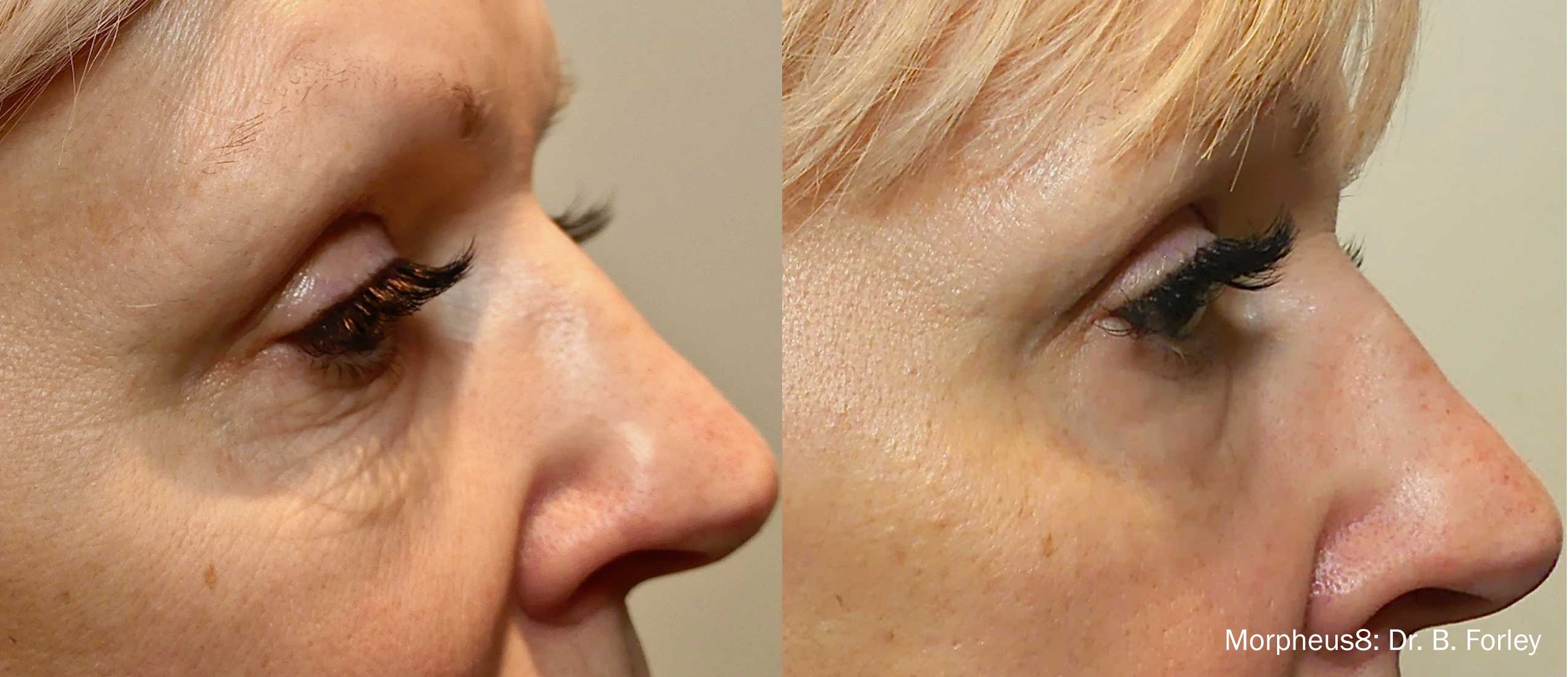 Morpheus8-Before-and-After-Under-Eye