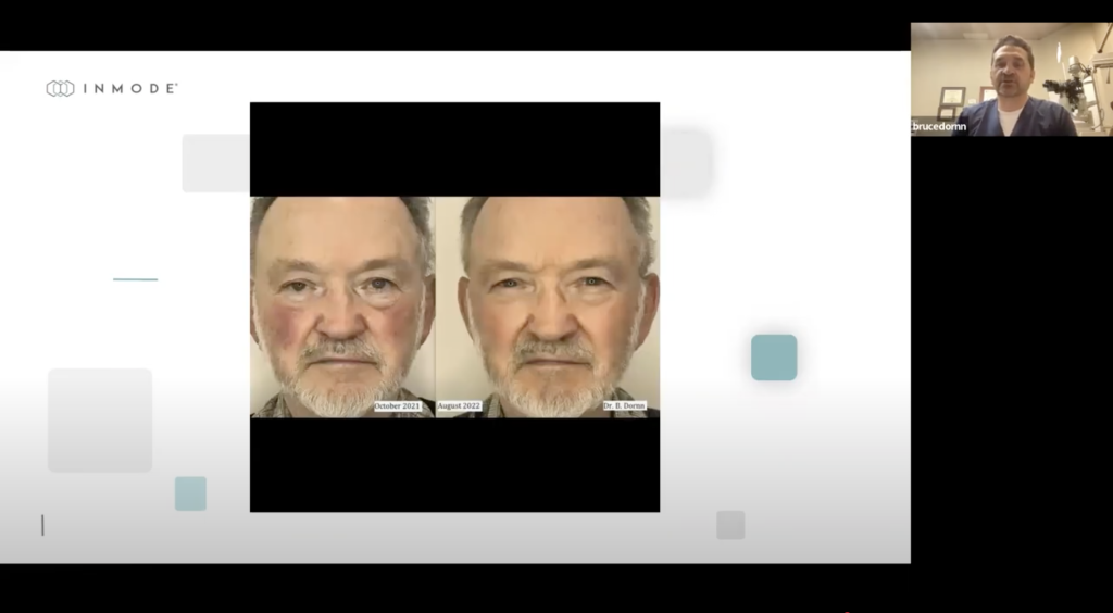 Webinar: Advanced Treatment of Dry Eye with Envision - Dr. Bruce Dornn