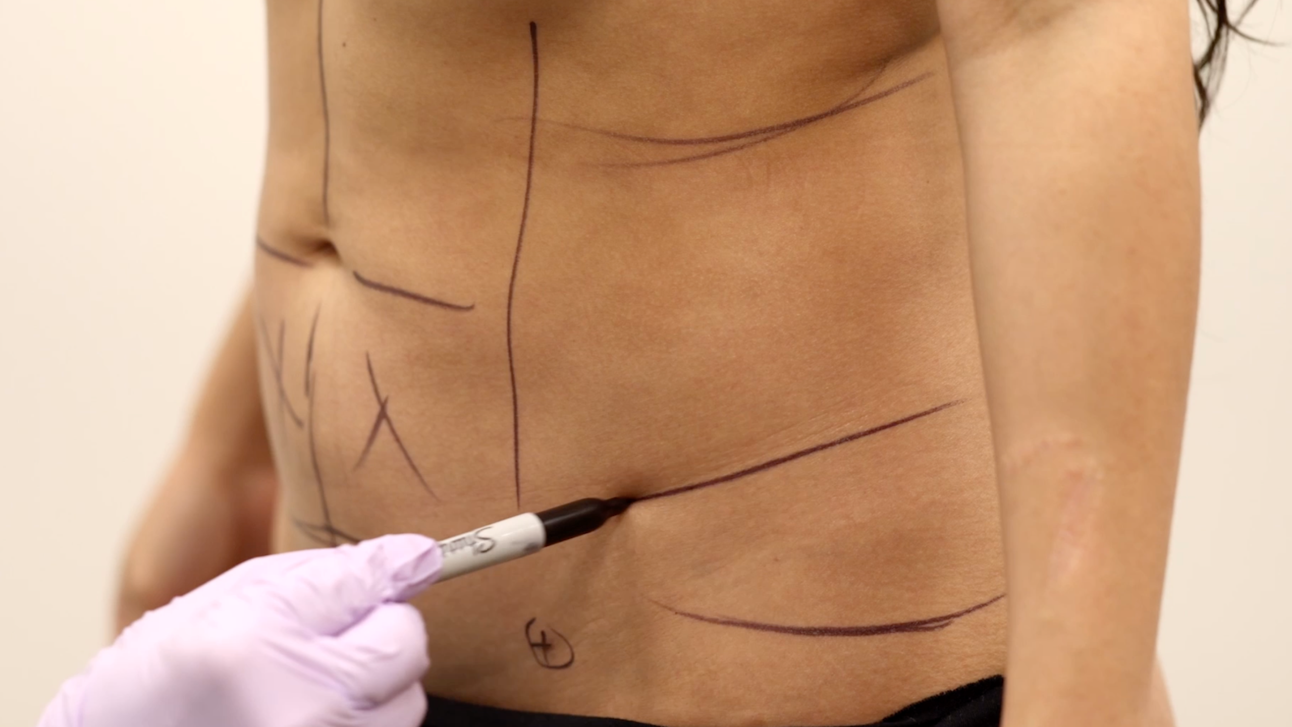 Pre-Operative Abdomen Markup – QuantumRF – Dr Forrest Roth