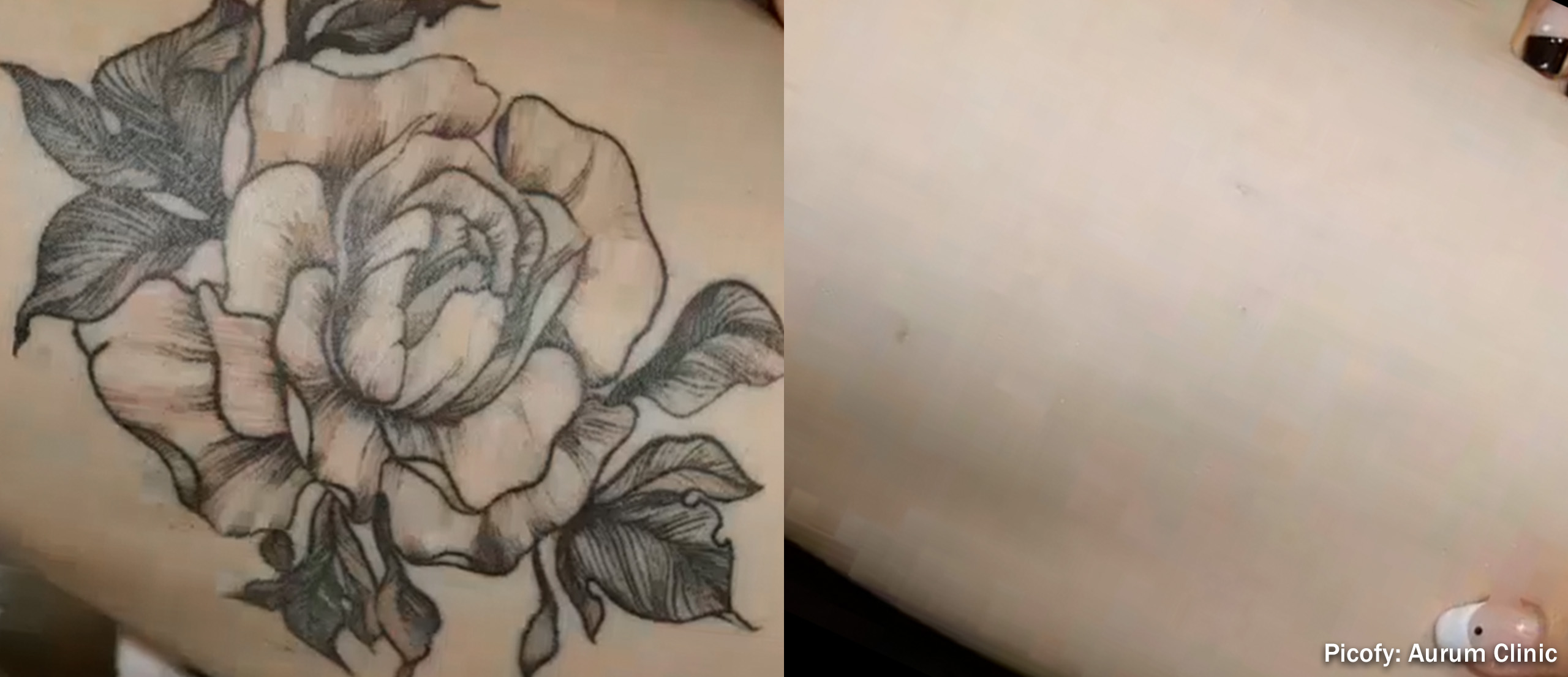 PICOFY before and after - tattoo removal