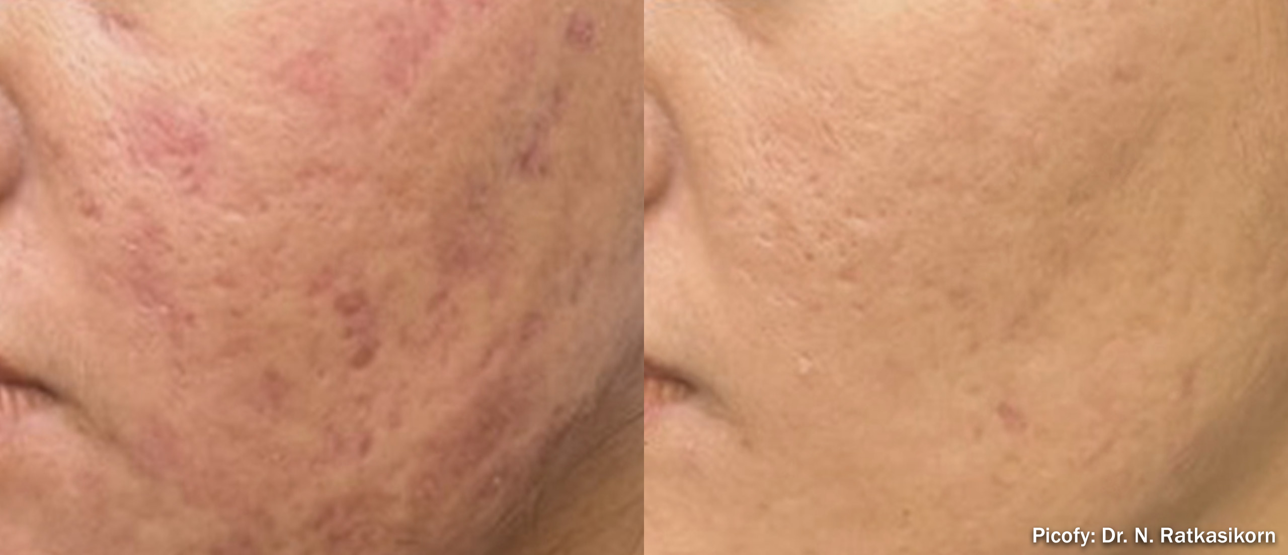 PICOFY before and after - acne scars