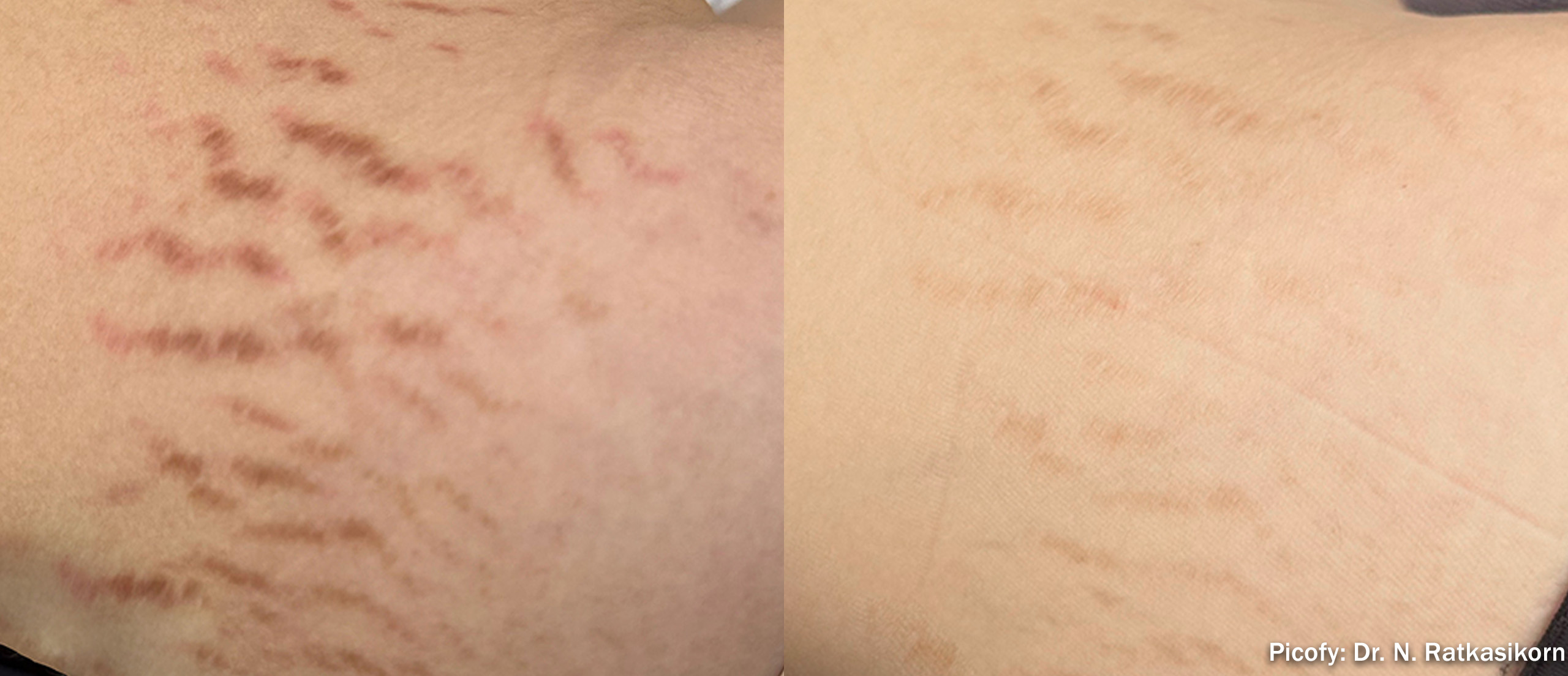 PICOFY before and after - stretch marks