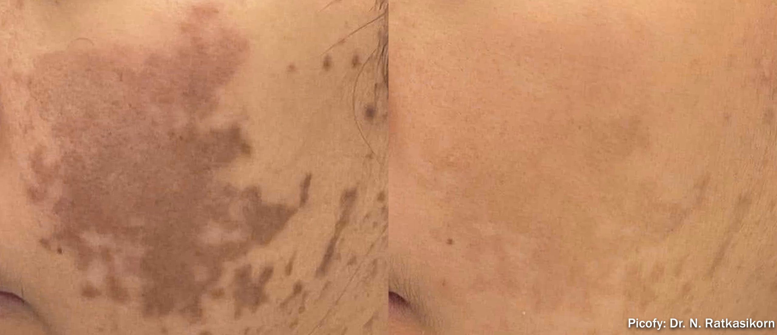 PICOFY before and after - melasma pigmentation
