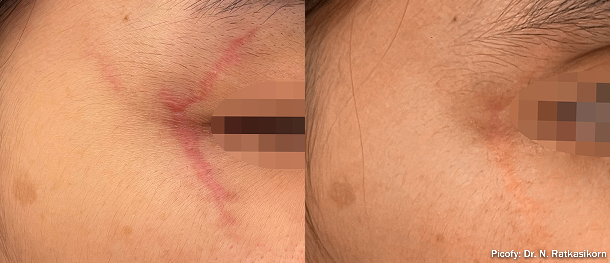 PICOFY before and after - facial scar removal