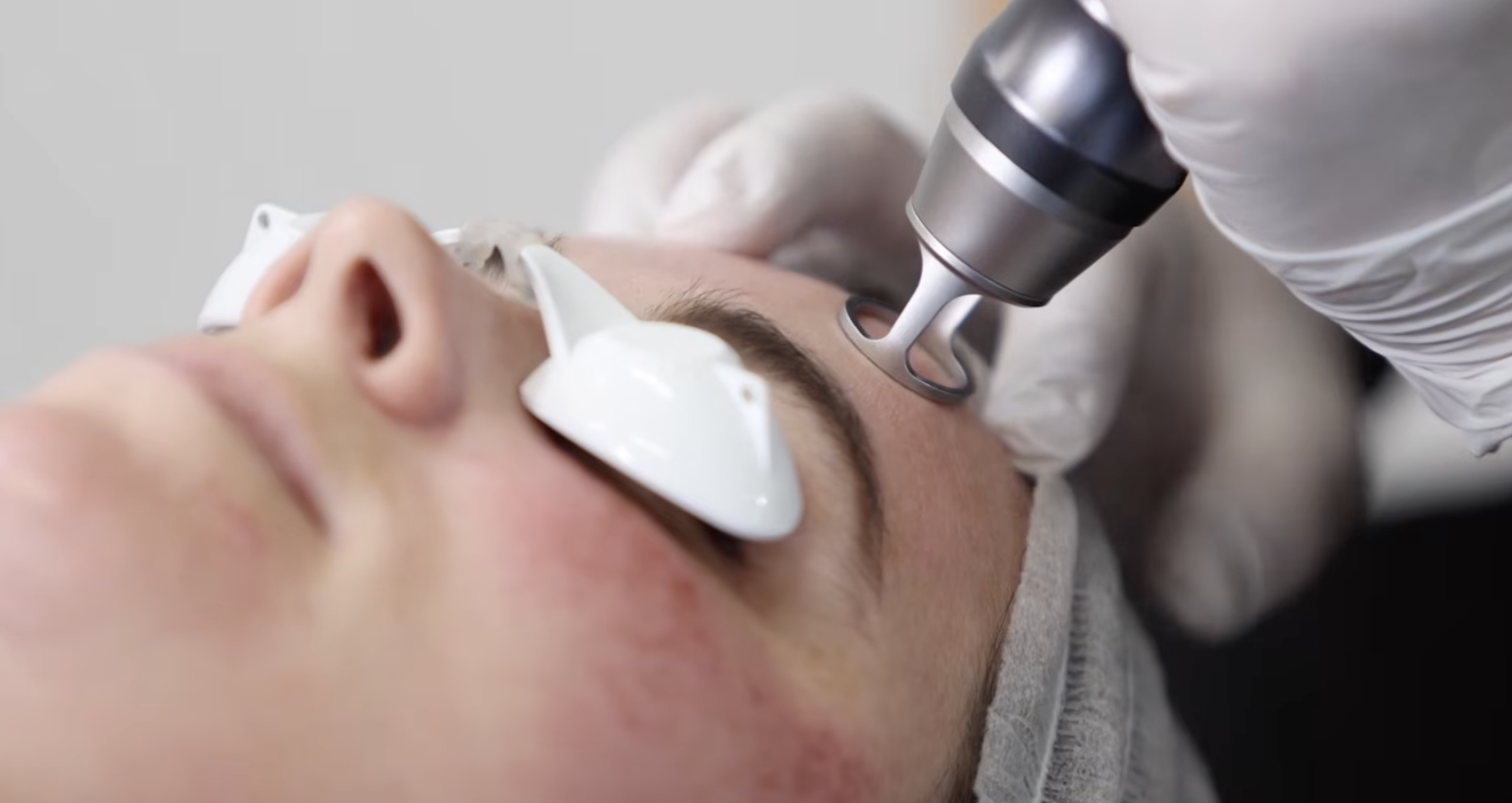Picofy by InMode Facial Wrinkle Treatment: Treatment Planning and Clinical Technique