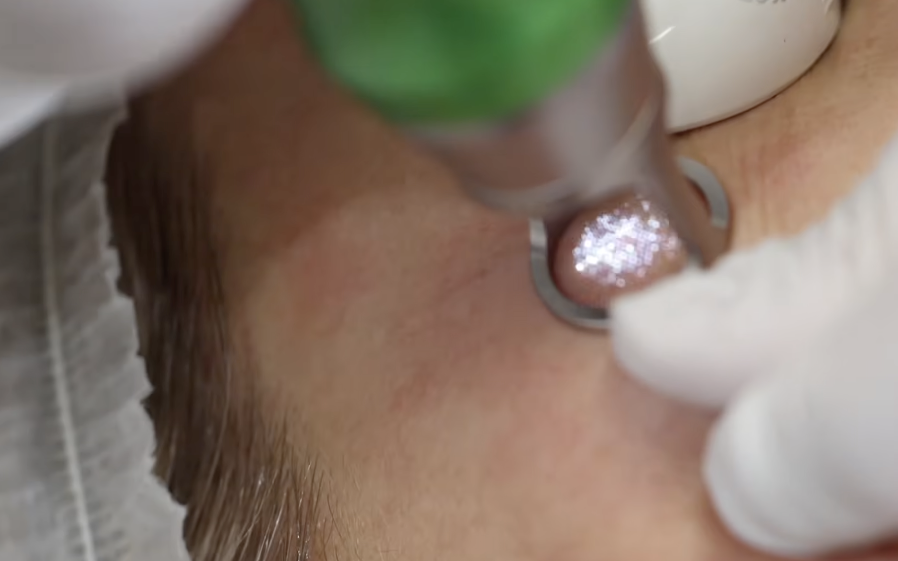 Picofy by InMode Fine Wrinkle Treatment: Precision Treatment Techniques and Parameter Selection
