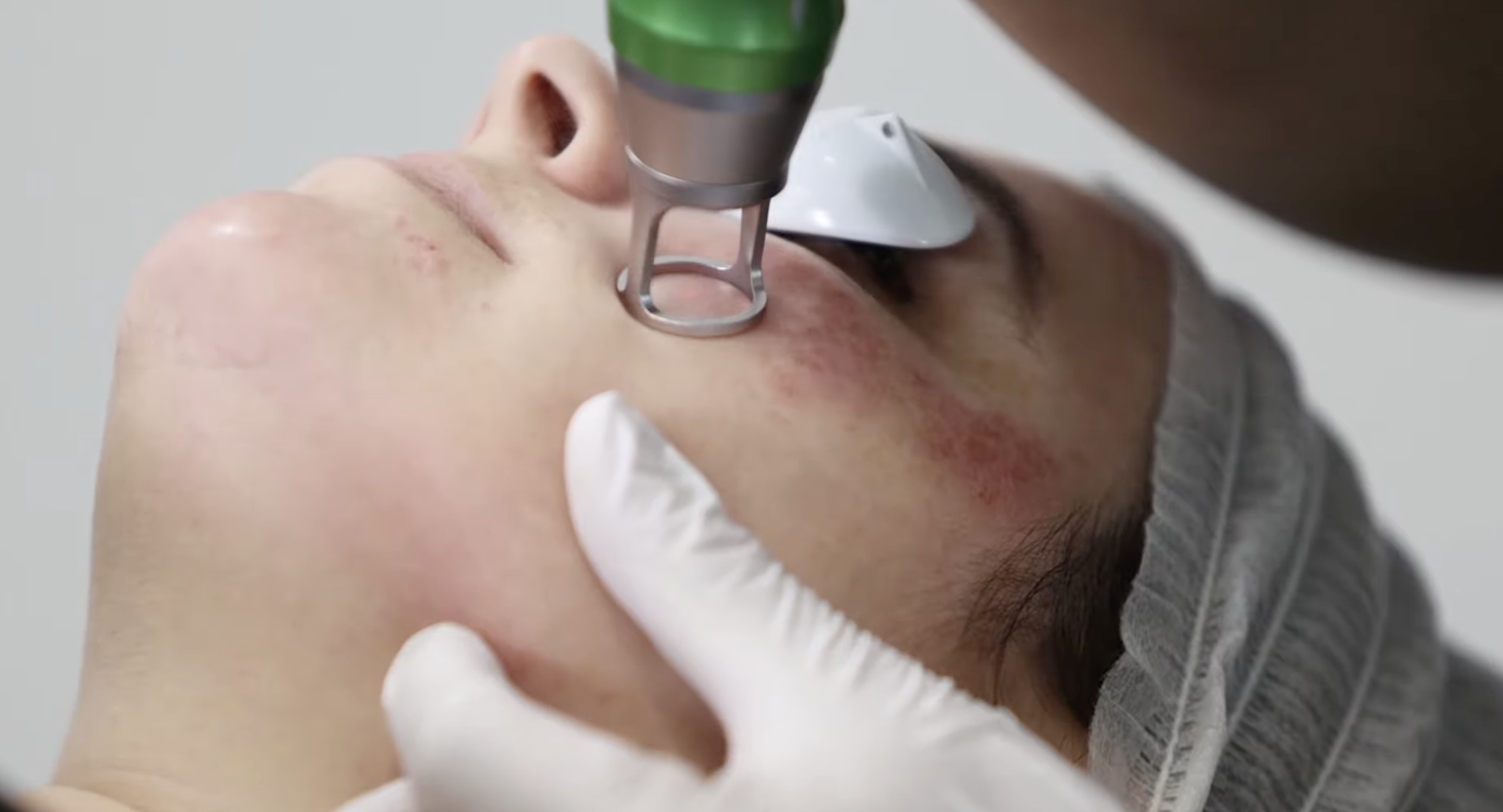 Picofy by InMode  Melasma and Mixed Pigmentation Treatment: Patient Selection and Clinical Considerations