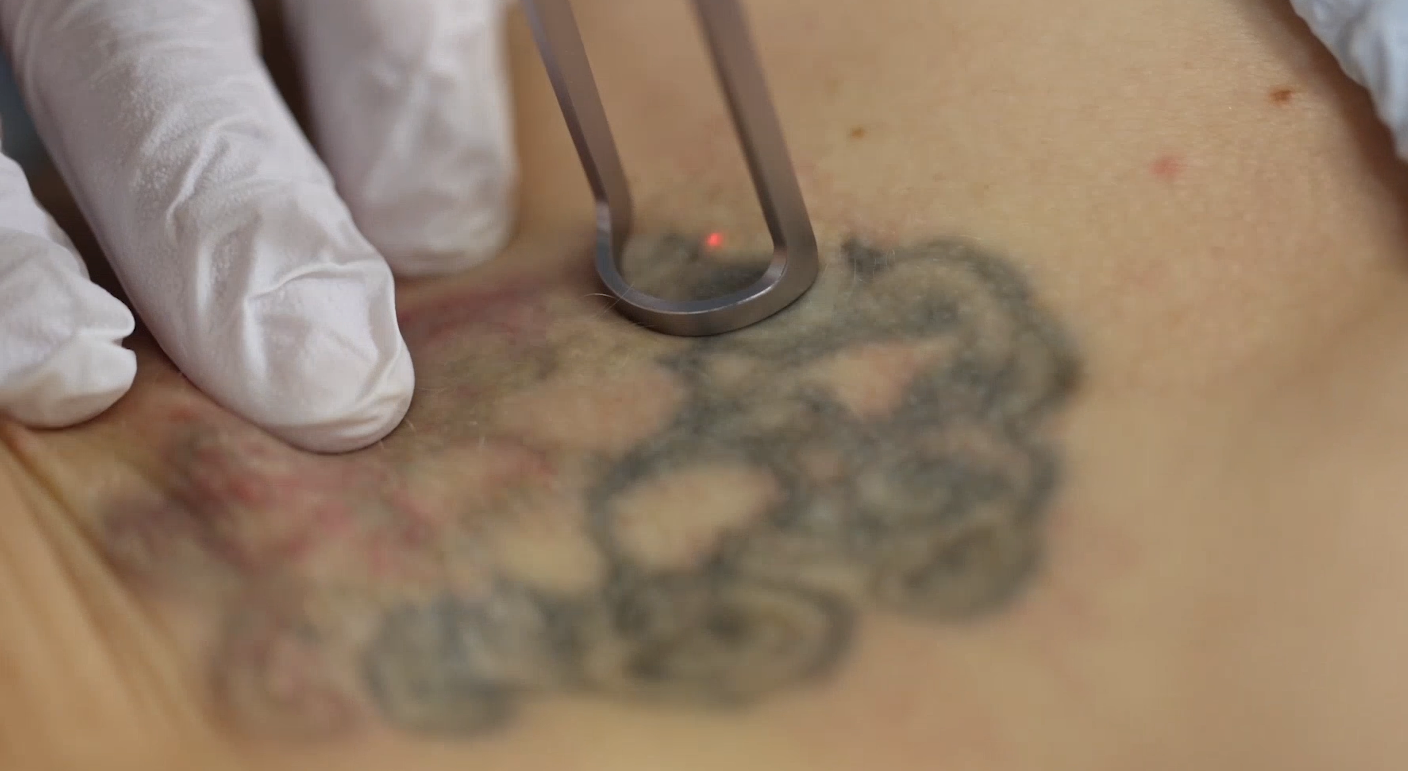 Picofy by InMode Tattoo Removal Fundamentals: Clinical Techniques and Treatment Best Practices