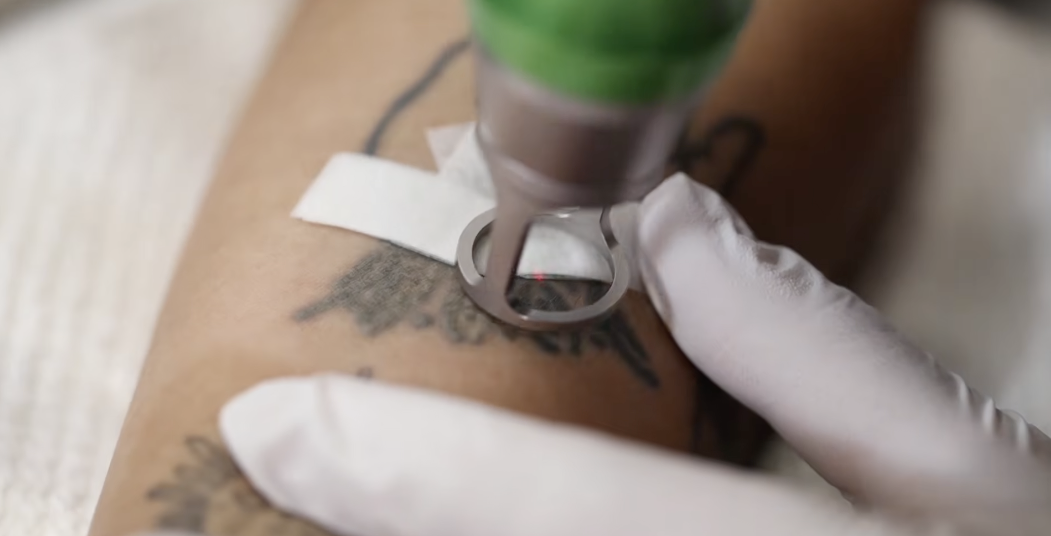 Picofy by InMode Partial Tattoo Removal: Targeted Tattoo Removal Techniques