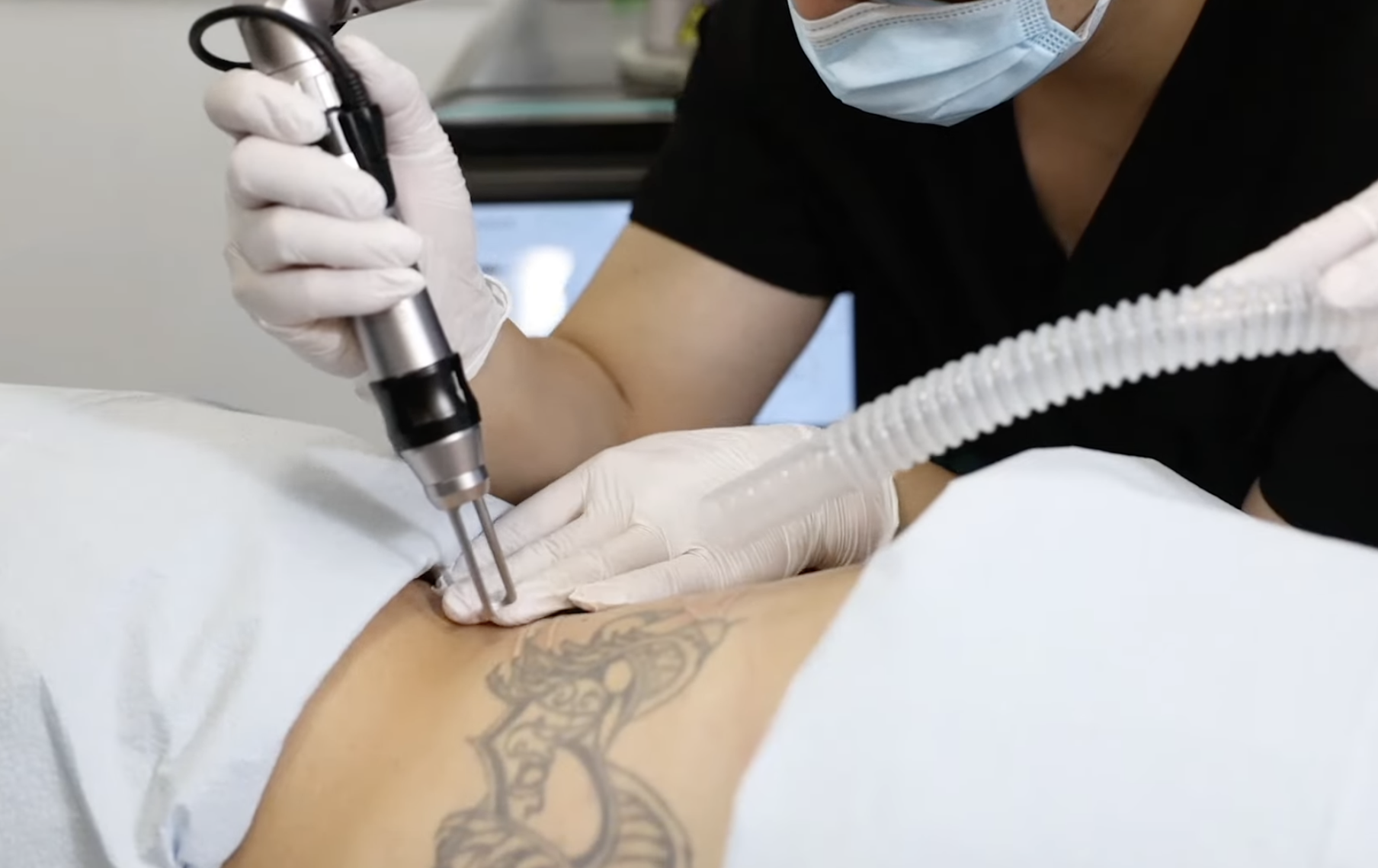 Picofy by InMode  Large Tattoo Removal: Efficient Treatment Strategies and Clinical Workflow for Large Tattoos