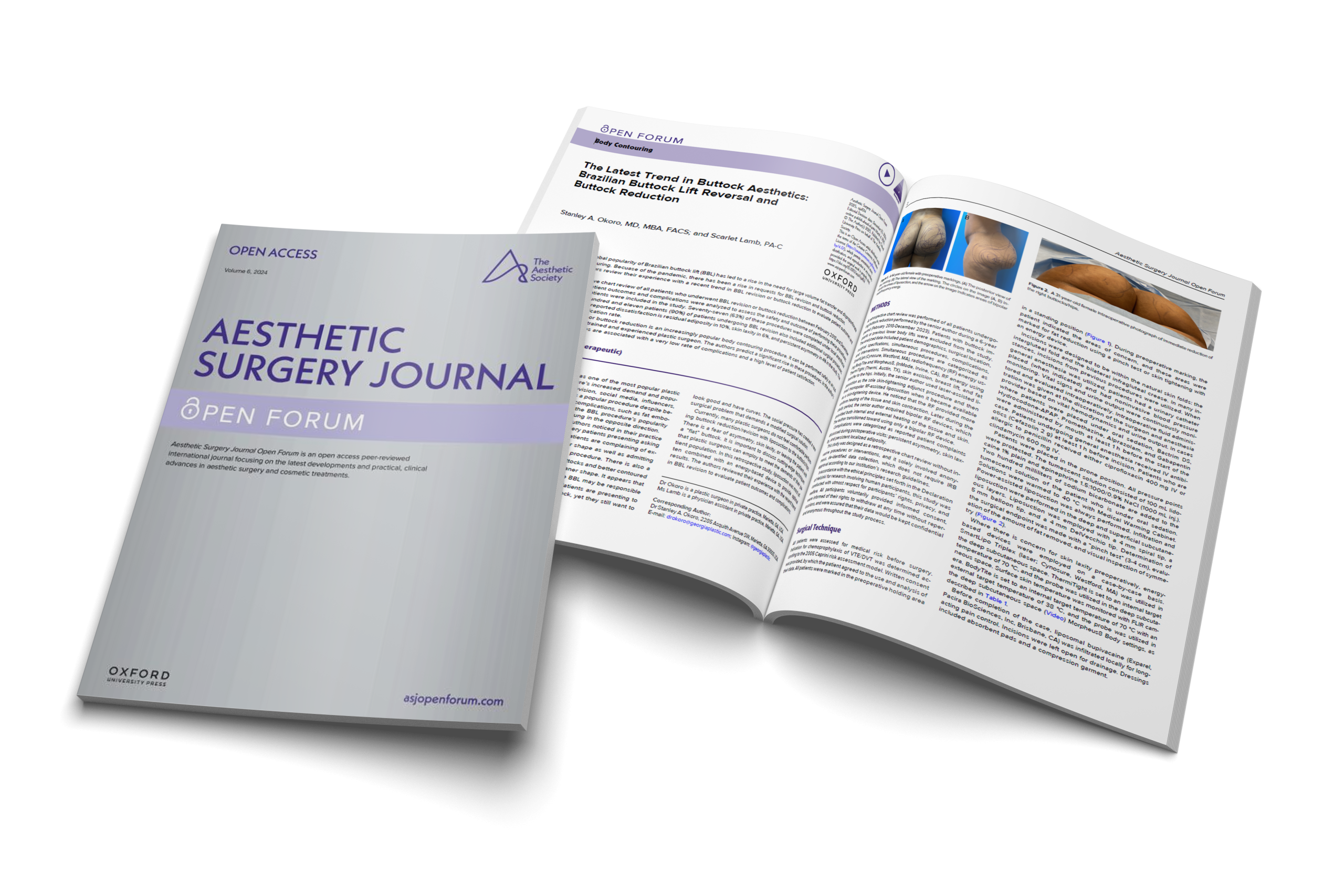 The Latest Trend in Buttock Aesthetics: Brazilian Buttock Lift Reversal and Buttock Reduction