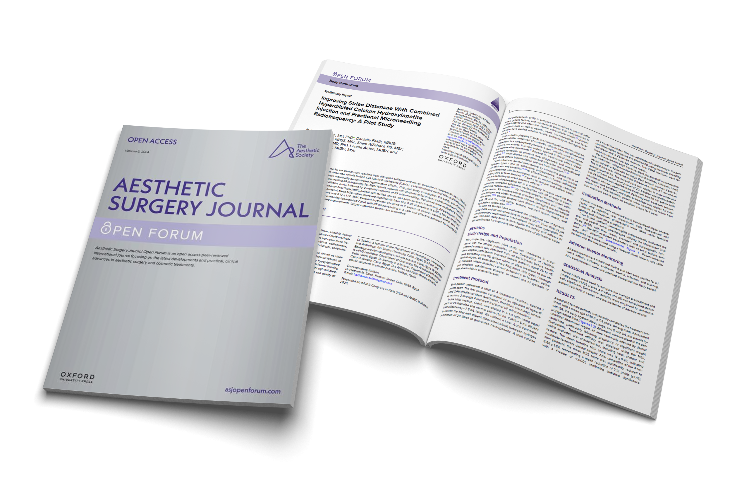 Improving Striae Distensae With Combined Hyperdiluted Calcium Hydroxylapatite Injection and Fractional Microneedling Radiofrequency: A Pilot Study